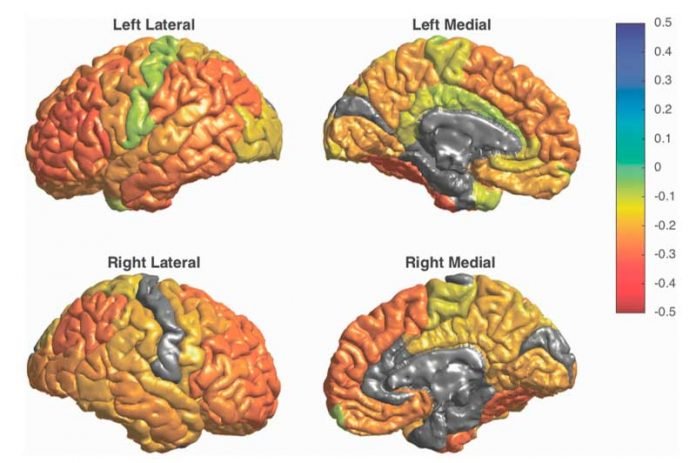 Alteraciones Estructurales Y Funcionales En El Cerebro De Las Personas